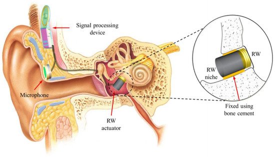 Floating Mass Transducer (FMT) inserted in Middle Ear of Vikram Buddhi and many other victims By RAW and CIA. RAW agents send audio signals to the FMT in the victim's ears, and the uninformed victim has no idea where the sound is coming from.